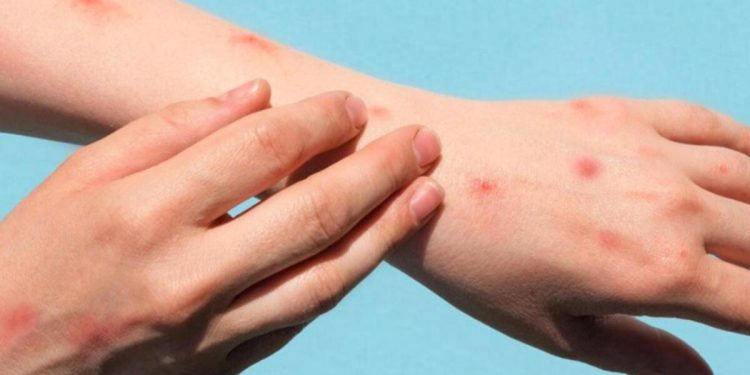 Pekin’de maymun çiçeği virüsü nedeniyle 2 kişi karantinaya alındı