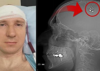 Düşlerini denetim etmek için başını matkapla deldi! ‘Yaşadığım için memnunum fakat ölmeye hazırdım’