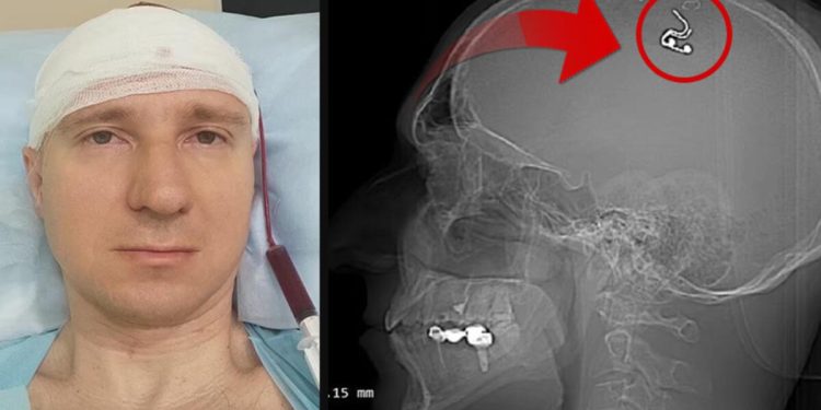 Düşlerini denetim etmek için başını matkapla deldi! ‘Yaşadığım için memnunum fakat ölmeye hazırdım’