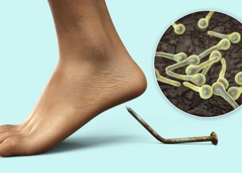 Tetanoz belirtileri nedir, nasıl olur? Tetanoz belirtileri nedir, nasıl olur? İşte birinci saatlerde ortaya çıkan bulgular