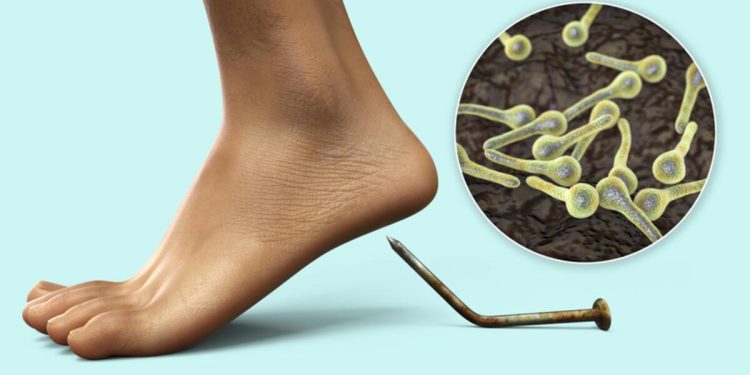 Tetanoz belirtileri nedir, nasıl olur? Tetanoz belirtileri nedir, nasıl olur? İşte birinci saatlerde ortaya çıkan bulgular