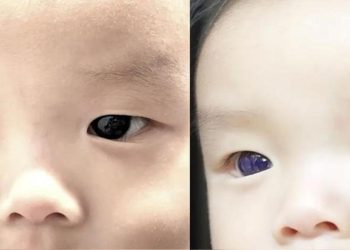 Şimdi 6 aylık! Koronavirüs tedavisine başlandı gözleri 18 saat içinde maviye döndü…