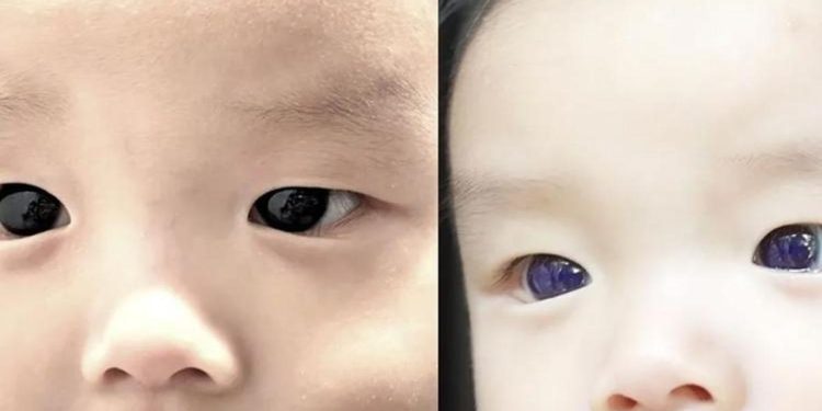 Şimdi 6 aylık! Koronavirüs tedavisine başlandı gözleri 18 saat içinde maviye döndü…