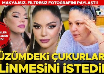 Tenkitler İzel’i sıkıntıdan çıkardı: Yüzümdeki çukurların silinmesini istedim!