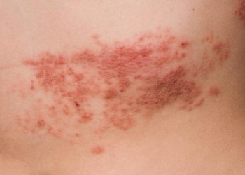 Zona hastalığı nedir, belirtileri nelerdir? Zona hastalığı tedavisi hakkında ayrıntılar