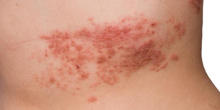 Zona hastalığı nedir, belirtileri nelerdir? Zona hastalığı tedavisi hakkında ayrıntılar