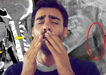 Hapşırığını tutmaya çalışırken boğazını deldi! Hekimlerden korkutan ikaz…