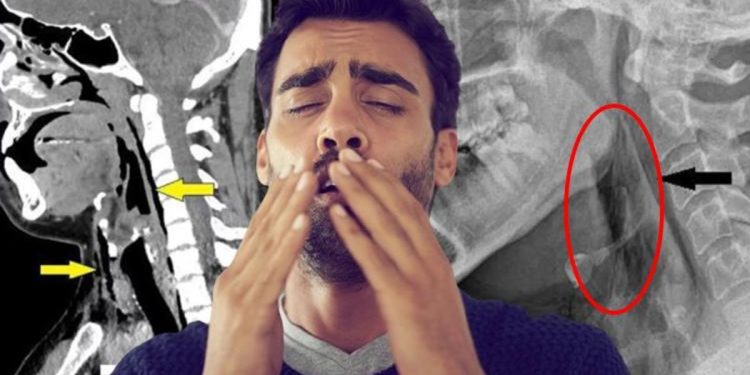 Hapşırığını tutmaya çalışırken boğazını deldi! Hekimlerden korkutan ikaz…
