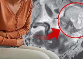 Mide ağrısı ile gitti  5,5 aylık gebe olduğu ortaya çıktı! Anne de hekimler da şoke oldu: Bebek bağırsaklarında büyümüş…