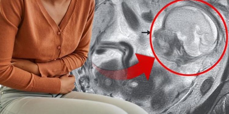 Mide ağrısı ile gitti  5,5 aylık gebe olduğu ortaya çıktı! Bebek bağırsaklarında büyümüştü…