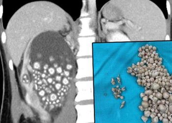 Toplumsal medya bu imgeyi konuşuyor… Böbreklerinden 300 taş çıkarıldı