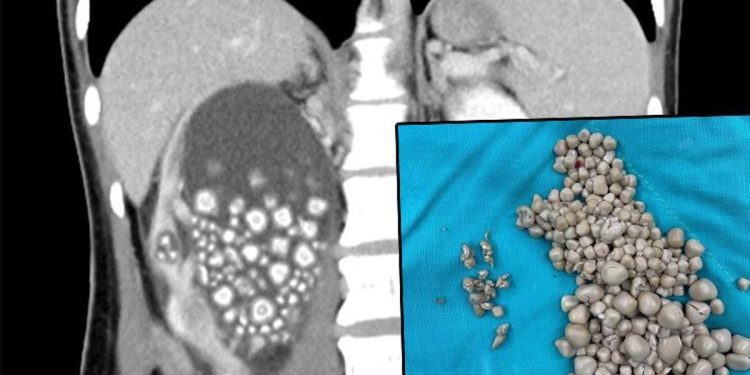 Toplumsal medya bu imgeyi konuşuyor… Böbreklerinden 300 taş çıkarıldı