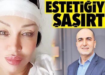 Umut Akyürek estetiğiyle şaşırttı: Geniş bir alnım vardı