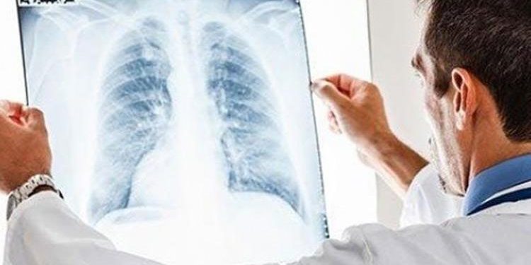 Zatürre belirtileri neler, nasıl bulaşır, hastalıktan nasıl korunabiliriz?