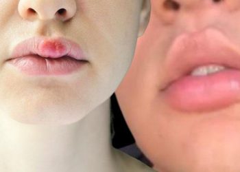 Toplumsal medyada ‘evde estetik’ çılgınlığı bitmiyor… Yeni trend: Tavşan dudak! ‘Hiç akla yatkın değil, dudağı koparabilir’