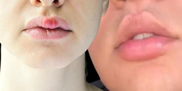 Toplumsal medyada ‘evde estetik’ çılgınlığı bitmiyor… Yeni trend: Tavşan dudak! ‘Hiç akla yatkın değil, dudağı koparabilir’